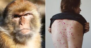 بالفيديو: كل ما يجب معرفته عن فيروس "جدري القردة" وطرق انتقاله